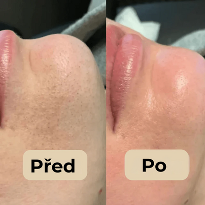 Korejský Peel Shot – Odstraňuje nečistoty a dodává pleti dokonalý vzhled